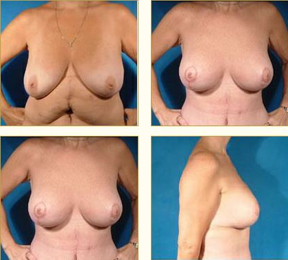 Before and after Breast Lift with Dr. John LoMonaco — case 6