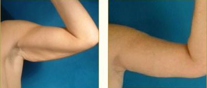 Before and after Arm Lift (Brachioplasty) with Dr. John LoMonaco — case 2