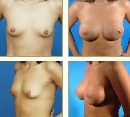 Before and after Breast Augmentation with Dr. John LoMonaco — case 1