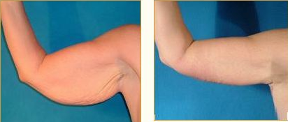 Before and after Arm Lift (Brachioplasty) with Dr. John LoMonaco — case 4