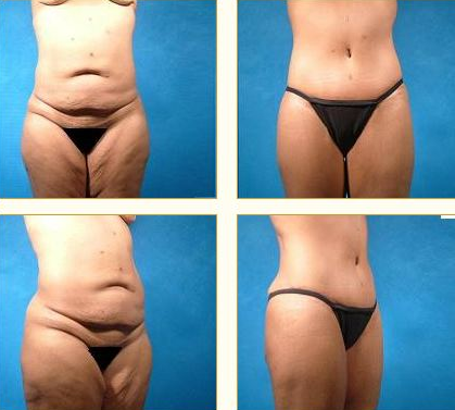 Before and after Tummy Tuck with Dr. John LoMonaco — case 1