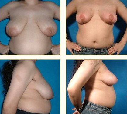 Before and after Breast Lift with Dr. John LoMonaco — case 3