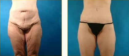 Before and after Leg Lift with Dr. John LoMonaco — case 4