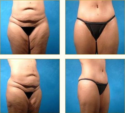 Before and after Leg Lift with Dr. John LoMonaco — case 1