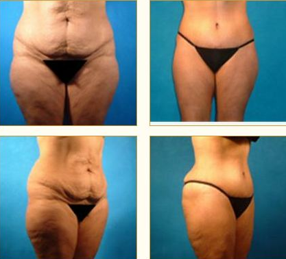 Before and after Tummy Tuck with Dr. John LoMonaco — case 6