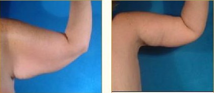 Before and after Arm Lift (Brachioplasty) with Dr. John LoMonaco — case 1