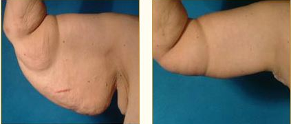 Before and after Arm Lift (Brachioplasty) with Dr. John LoMonaco — case 3