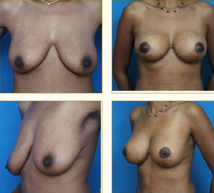Before and after Breast Lift with Dr. John LoMonaco — case 8