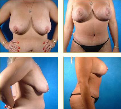 Before and after Breast Lift with Dr. John LoMonaco — case 1