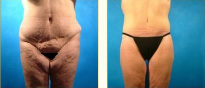 Before and after Leg Lift with Dr. John LoMonaco — case 3