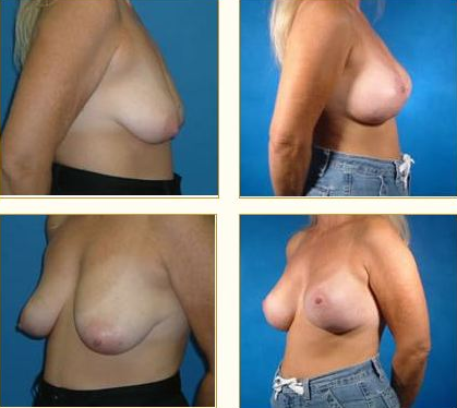 Before and after Breast Lift with Dr. John LoMonaco — case 7