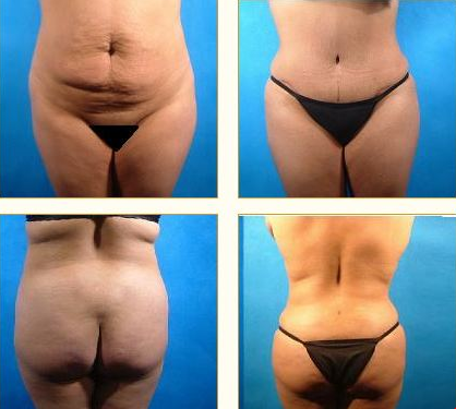 Before and after Tummy Tuck with Dr. John LoMonaco — case 2
