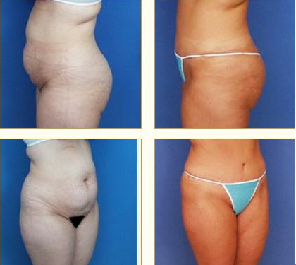 Before and after Tummy Tuck with Dr. John LoMonaco — case 5