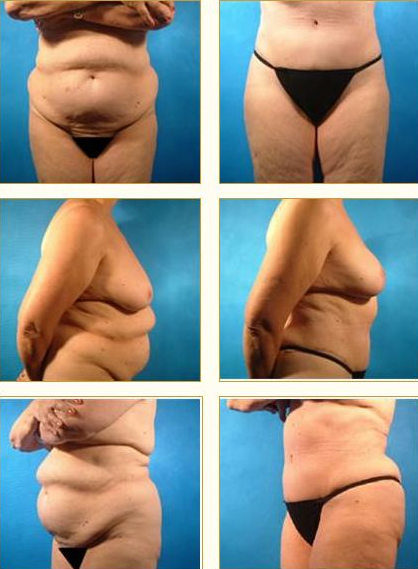 Before and after Tummy Tuck with Dr. John LoMonaco — case 7