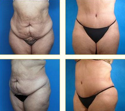 Before and after Tummy Tuck with Dr. John LoMonaco — case 3
