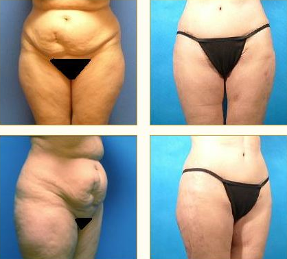 Before and after Leg Lift with Dr. John LoMonaco — case 2