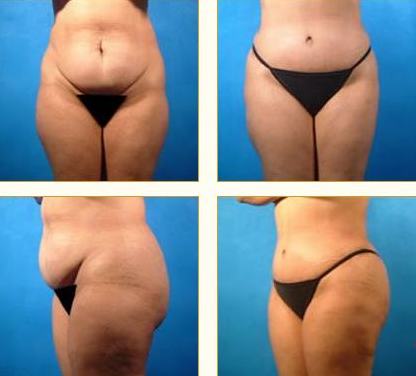 Before and after Tummy Tuck with Dr. John LoMonaco — case 4