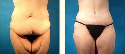 Before and after Thigh Lift (Thighplasty) with Dr. John LoMonaco — case 1
