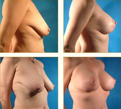 Before and after Breast Lift with Dr. John LoMonaco — case 5