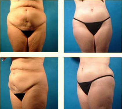 Before and after Tummy Tuck with Dr. John LoMonaco — case 8