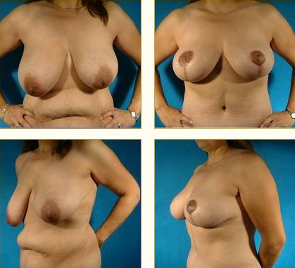 Before and after Breast Lift with Dr. John LoMonaco — case 2